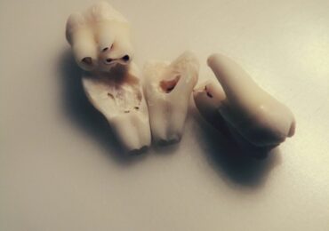 "Wisdom Teeth"